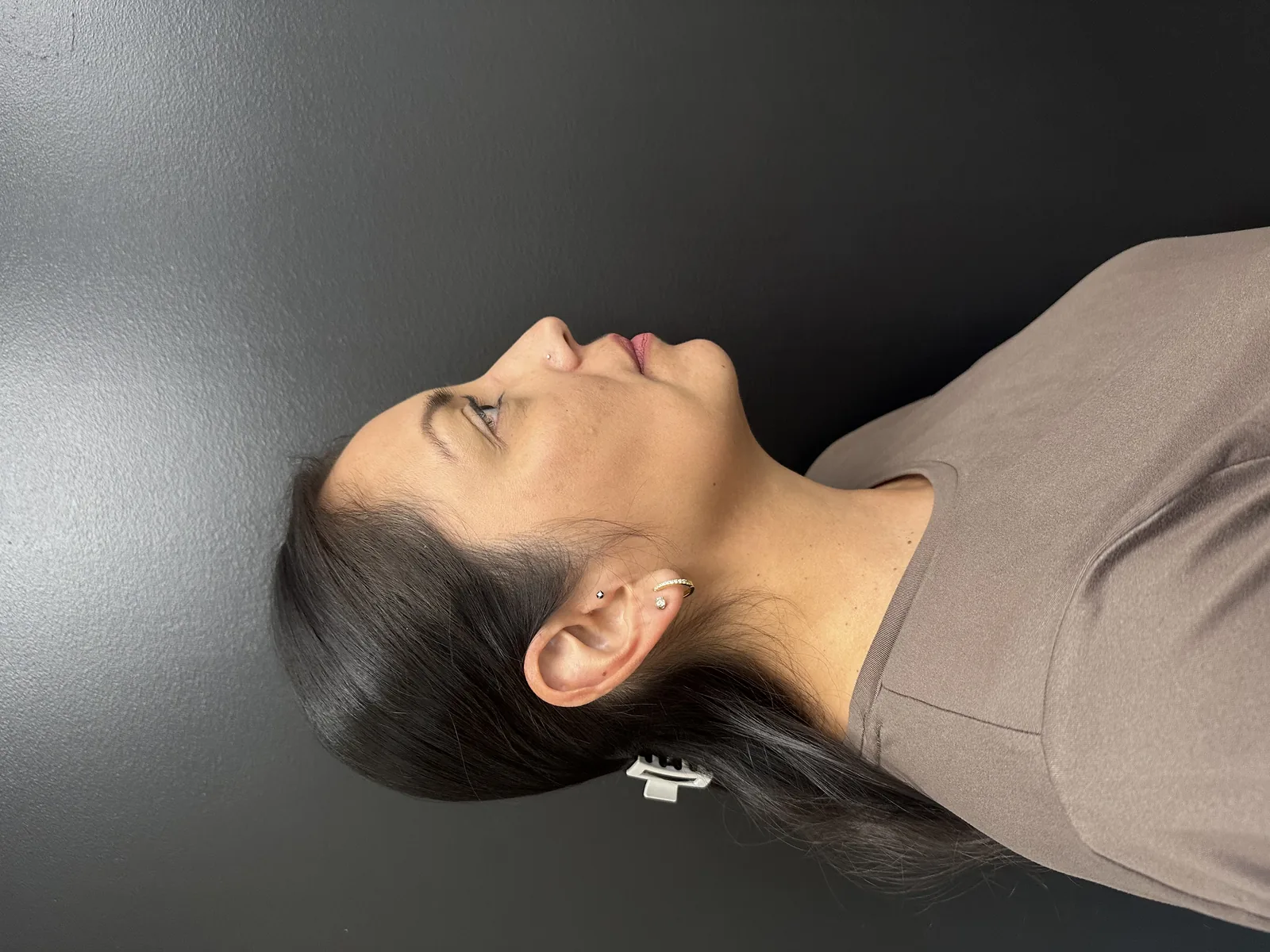 After Aerolase treatment