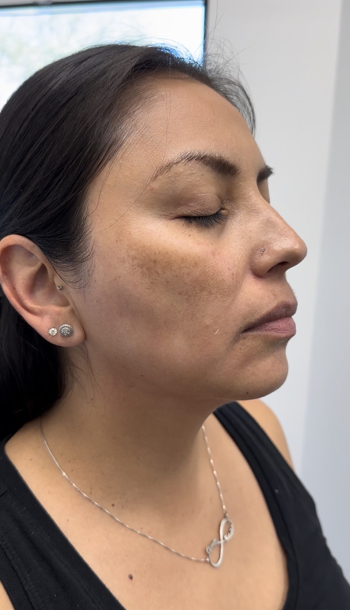 Before Aerolase treatment