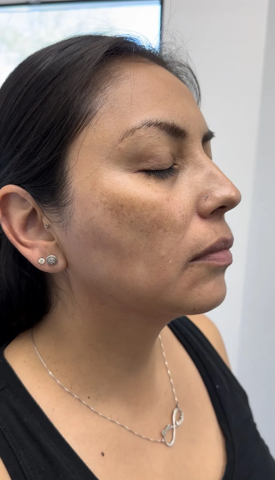 Before Aerolase treatment