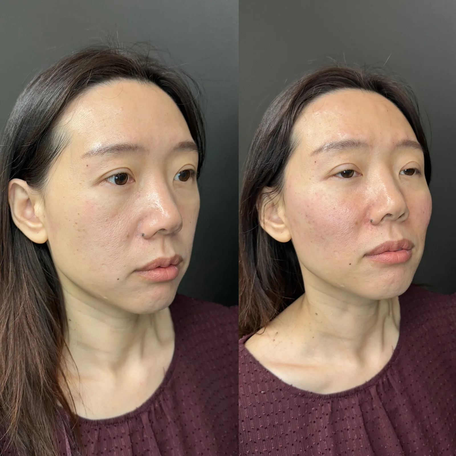 Biostimulators before and after result 1