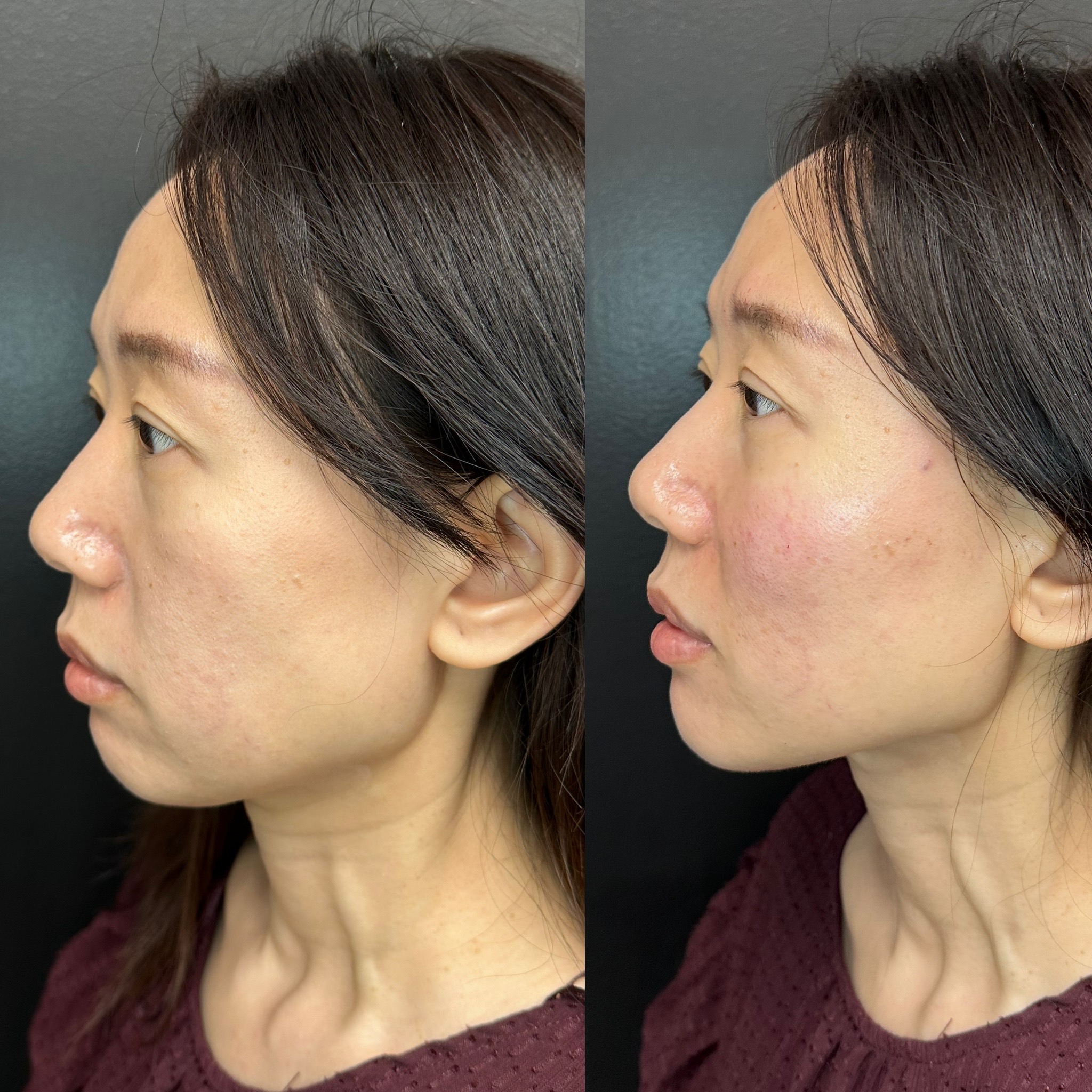Biostimulators before and after result 2