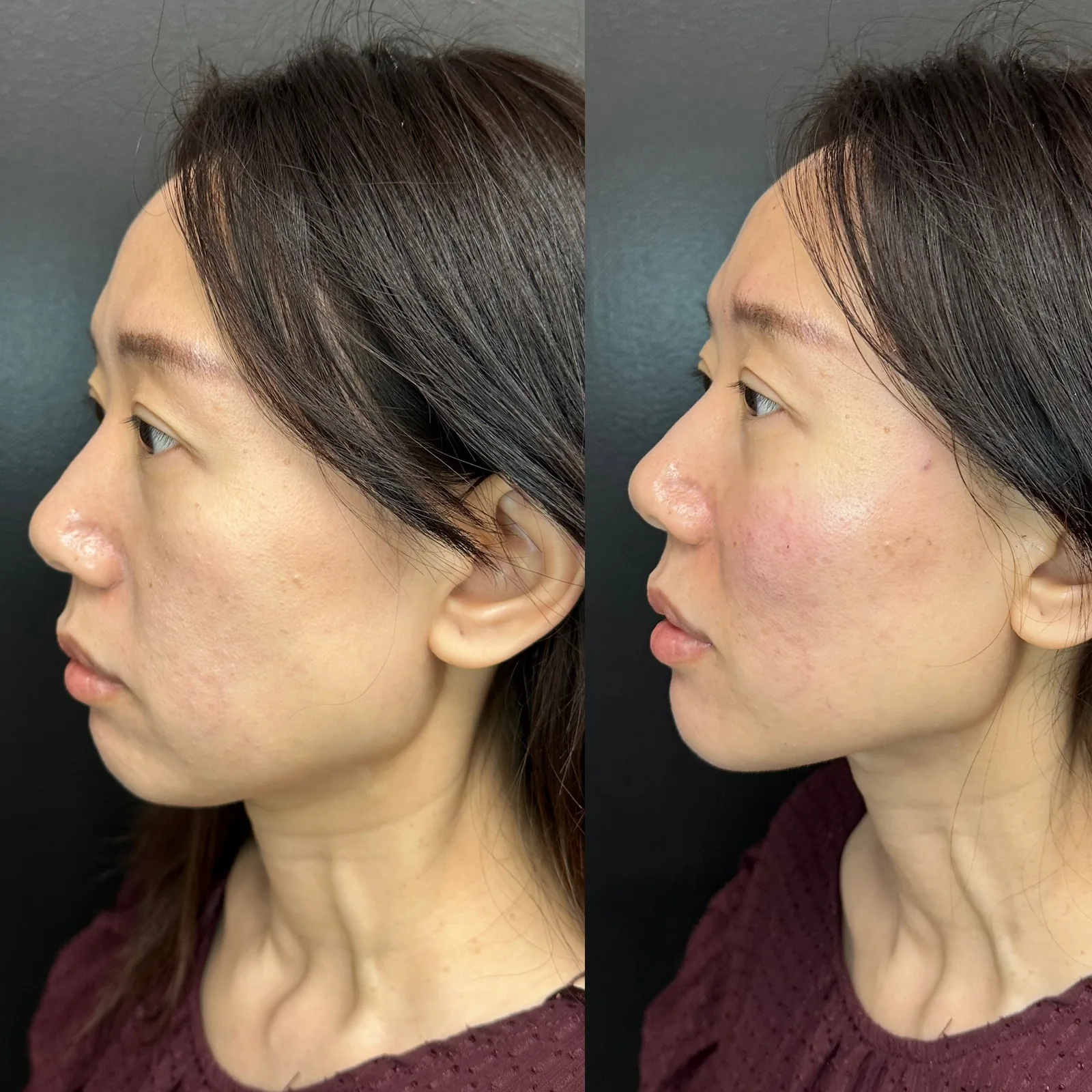 Biostimulators before and after result 2