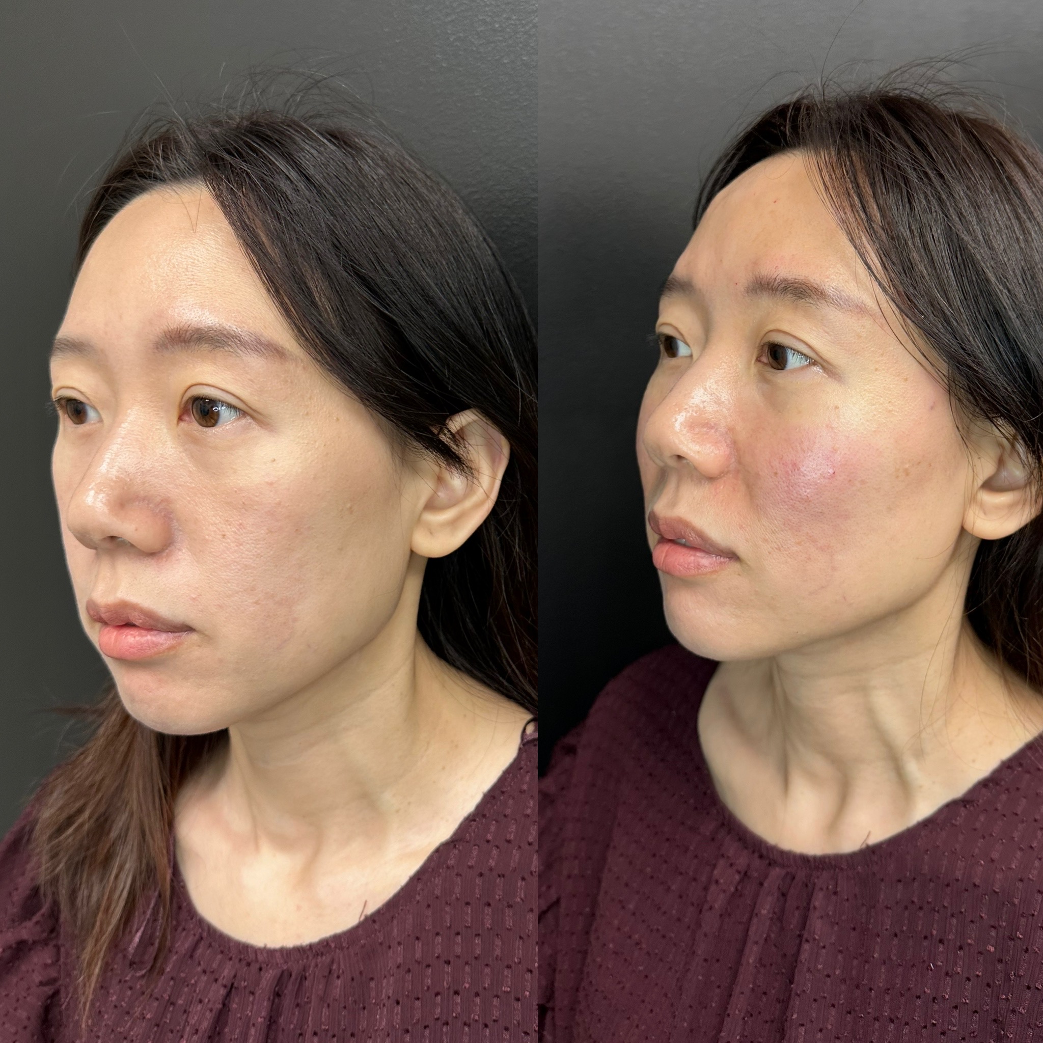 Biostimulators before and after result 3