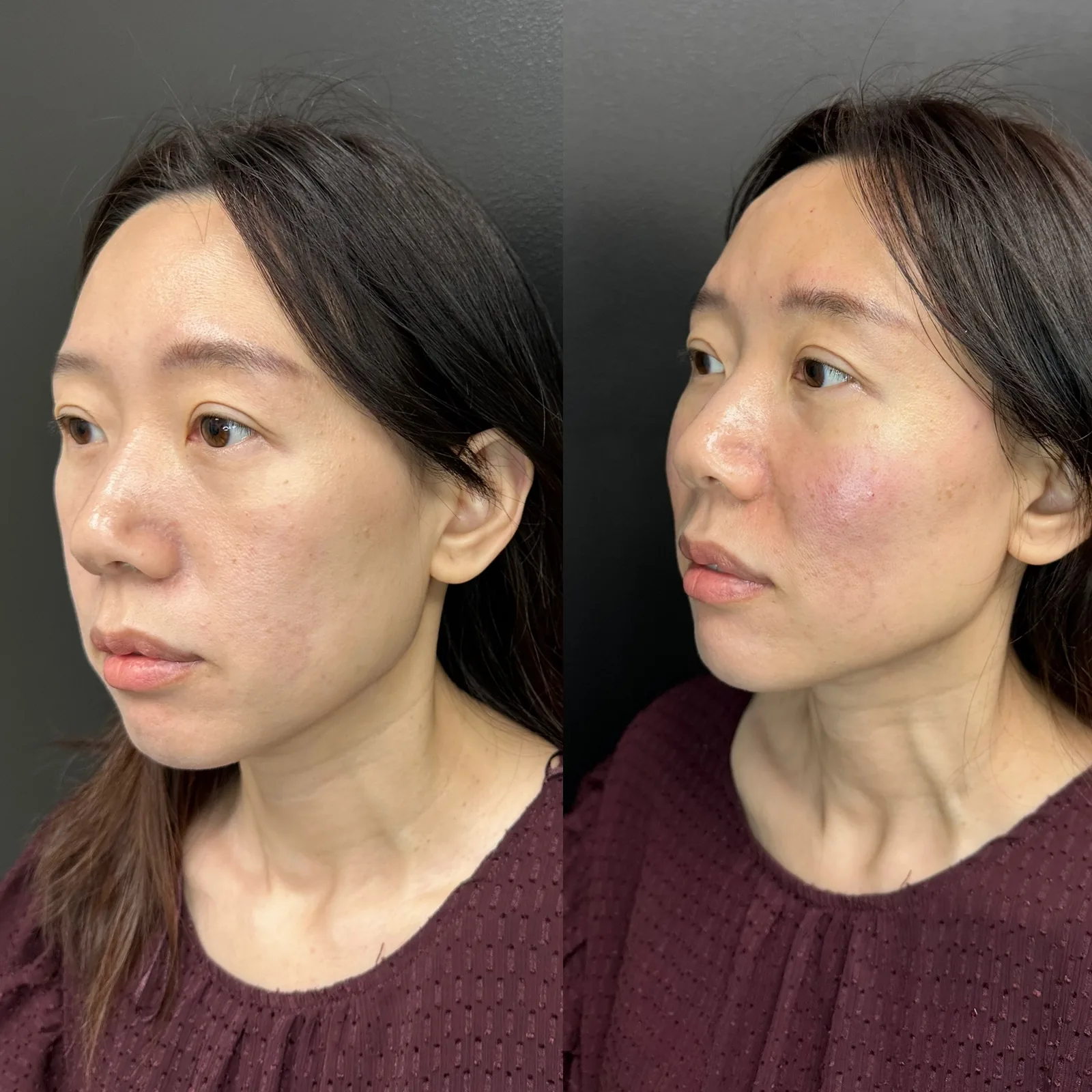 Biostimulators before and after result 3