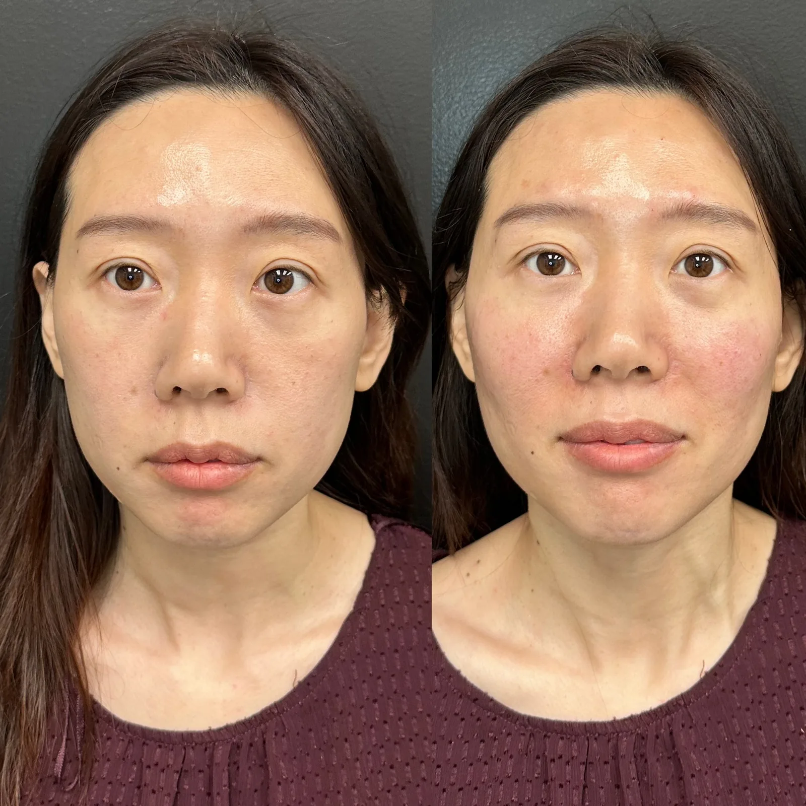 Biostimulators before and after result 4
