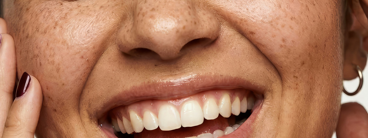 Smile line filler treatment