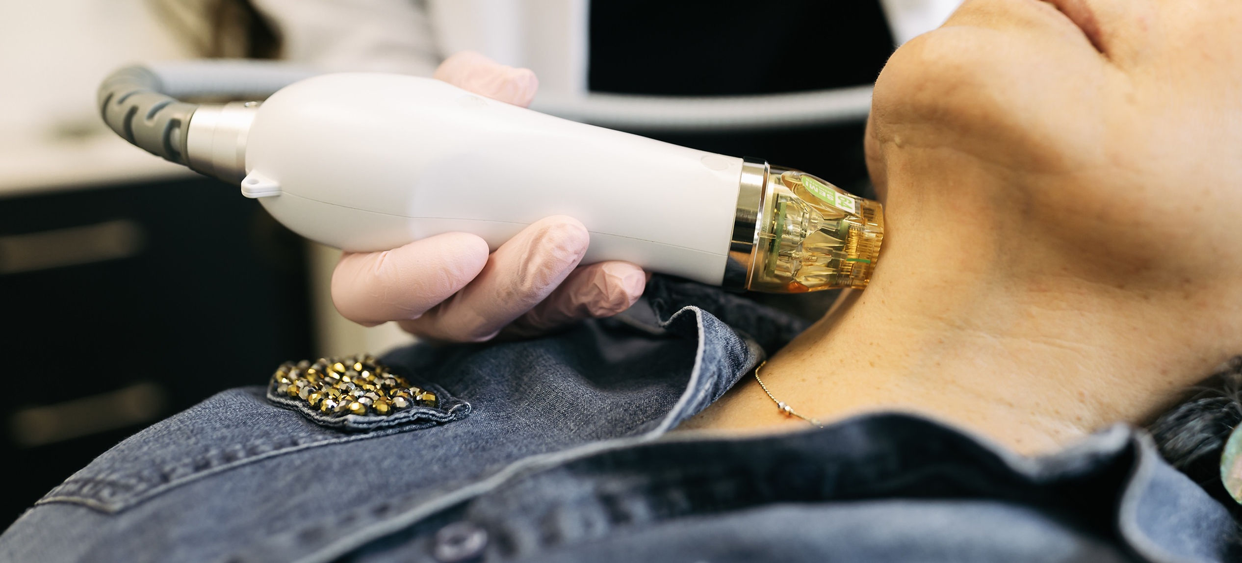 Microneedling treatment