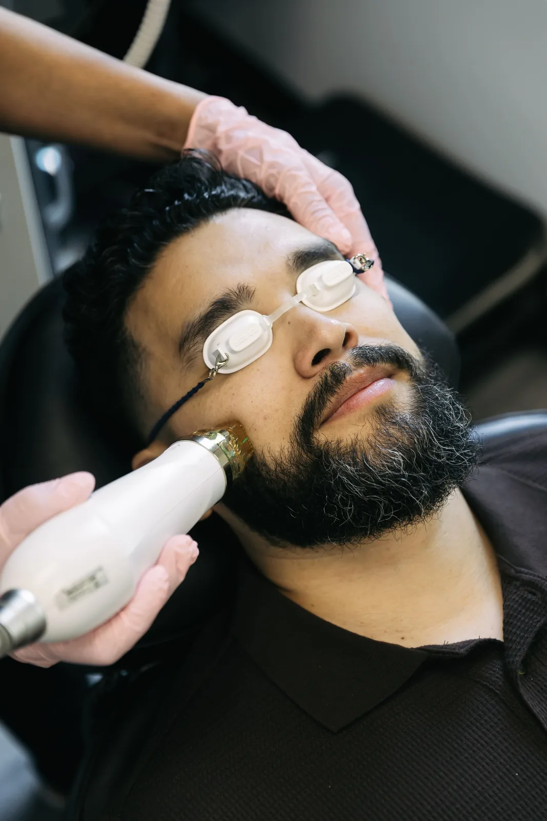 Traditional microneedling treatment