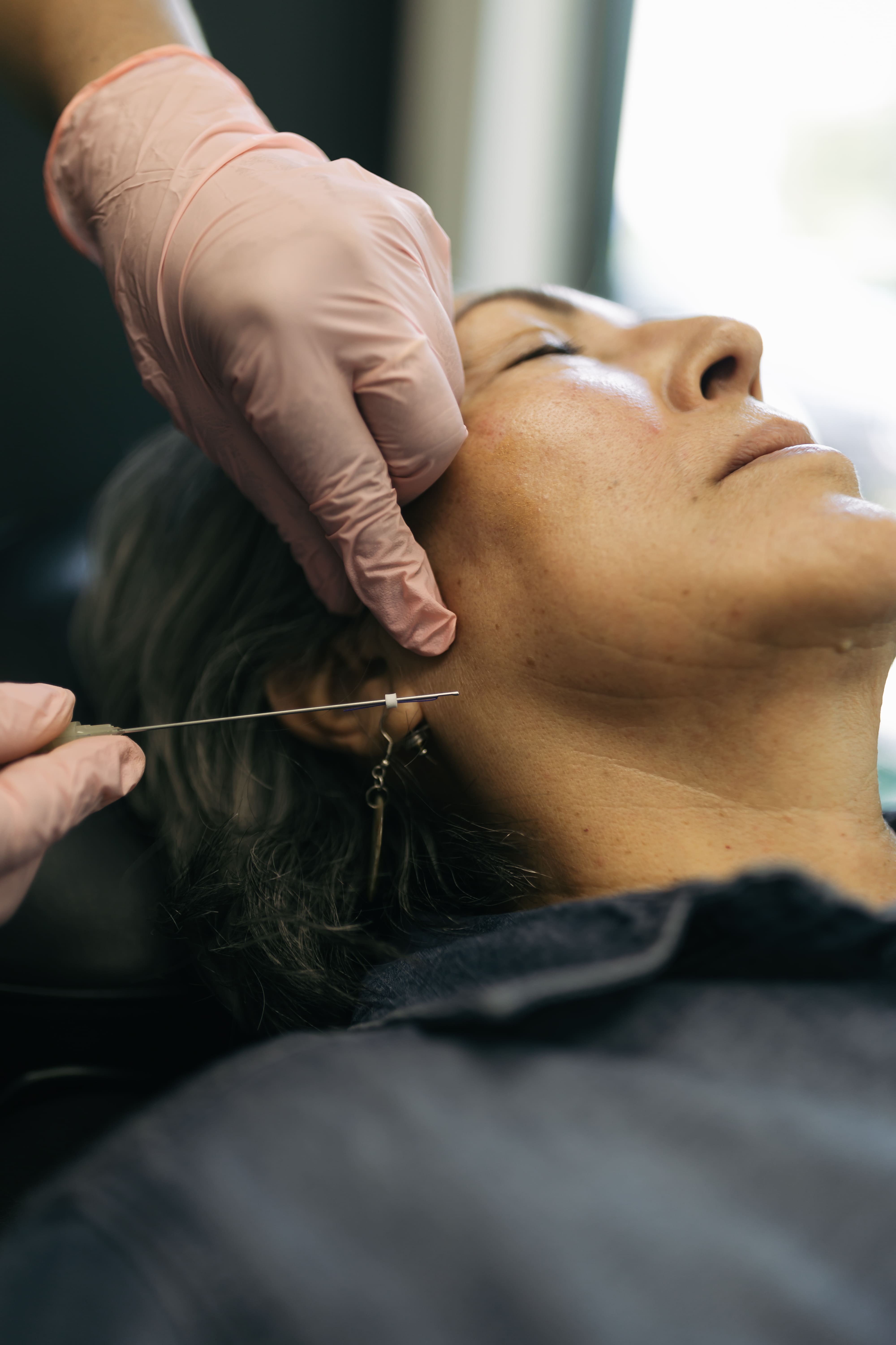 PDO thread lift treatment