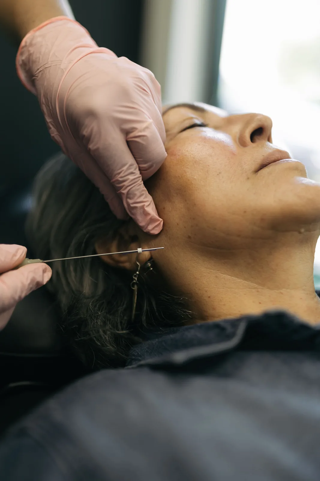 PDO thread lift treatment