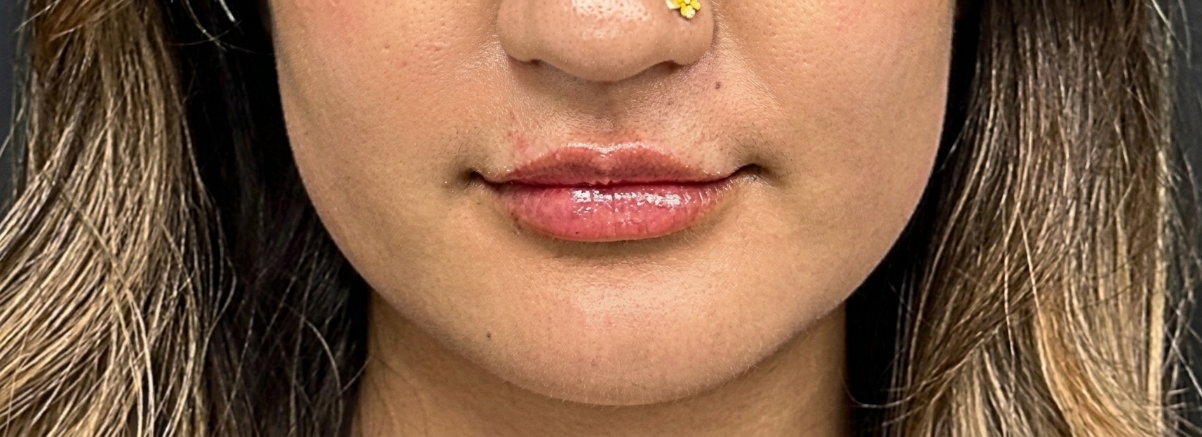 After dermal filler treatment