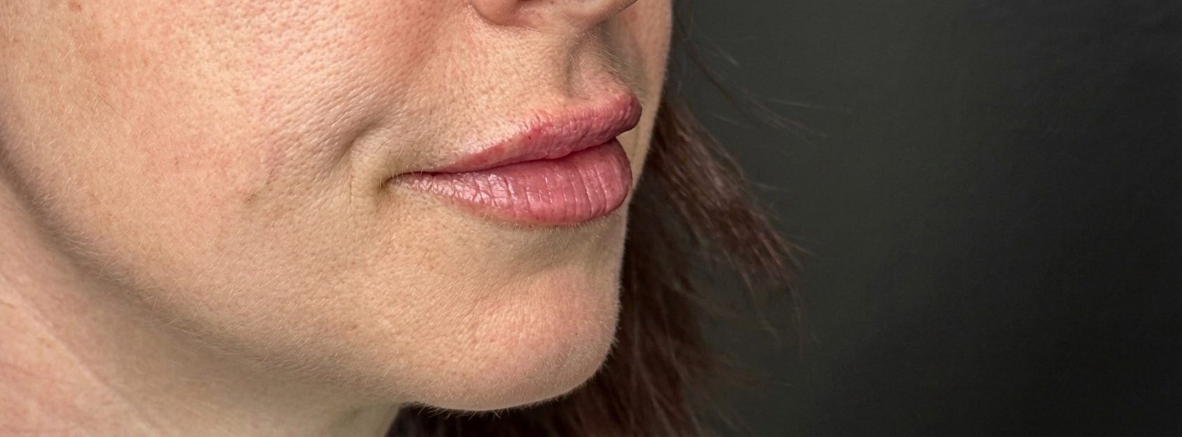 After dermal filler treatment