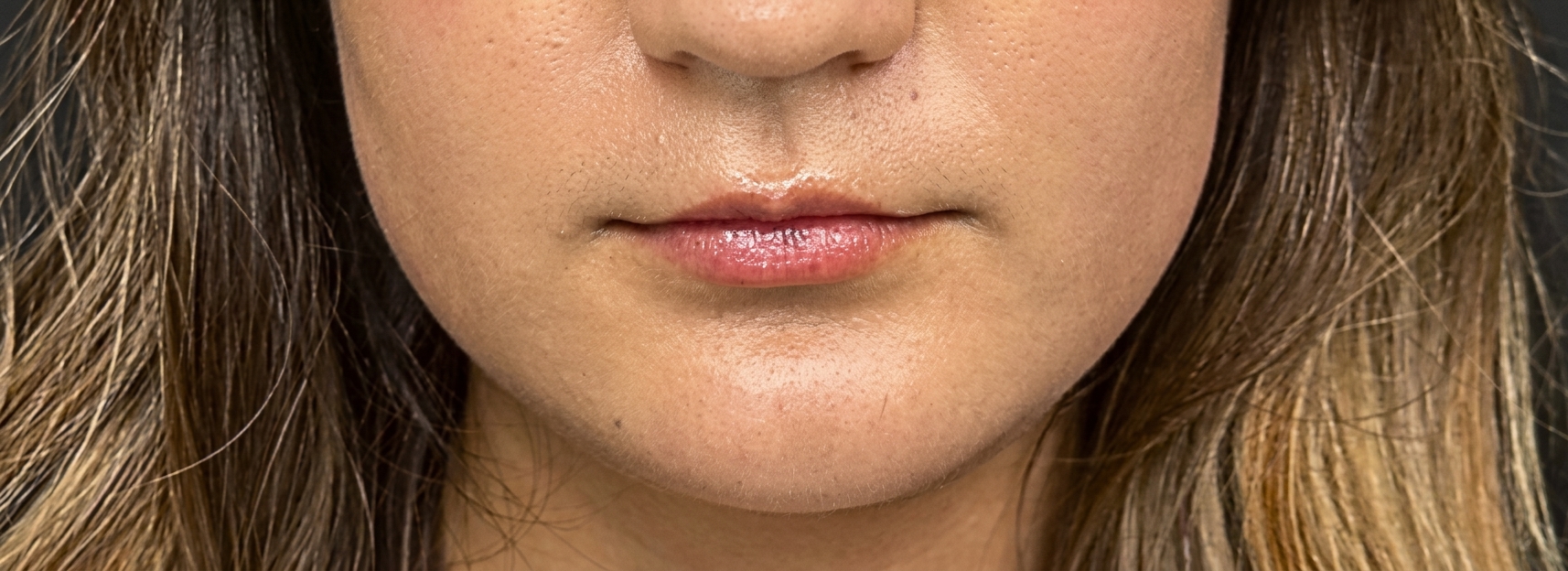 Before dermal filler treatment