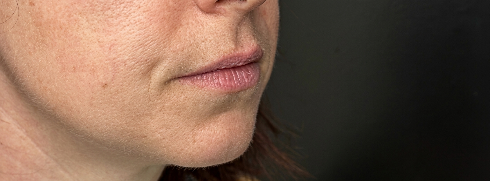 Before dermal filler treatment