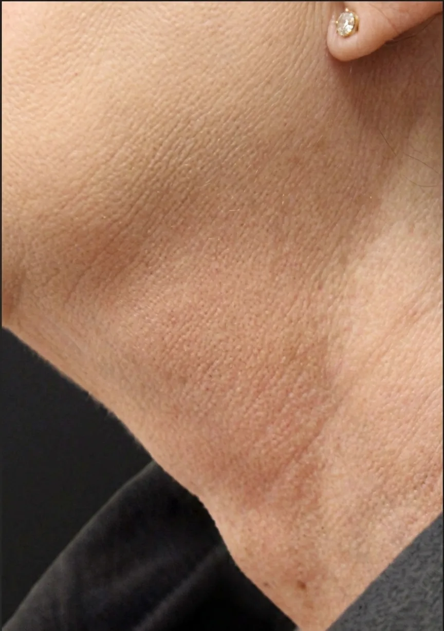RF Microneedling with PRP before and after results, EFW Medspa