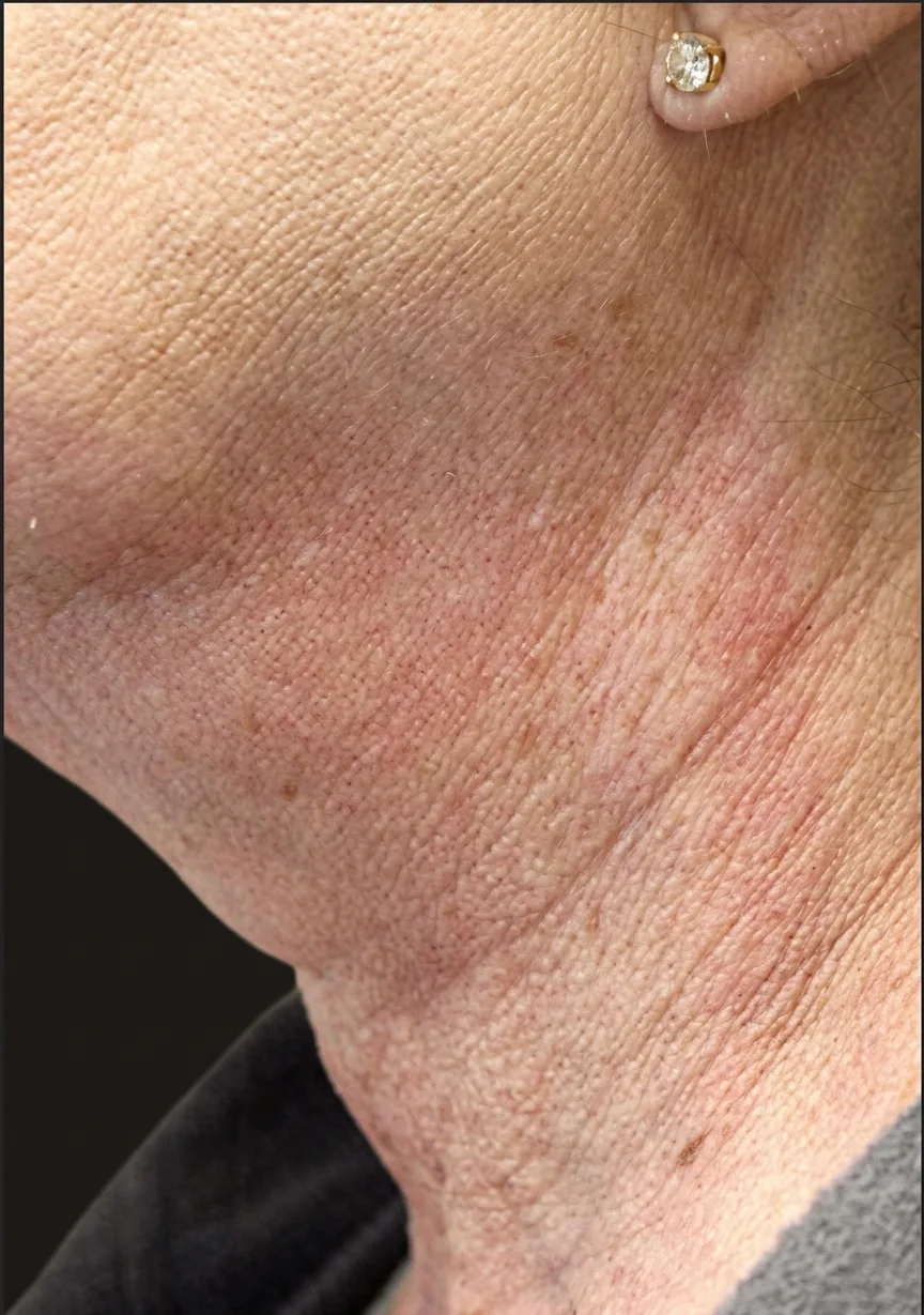 RF Microneedling with PRP before and after results, EFW Medspa