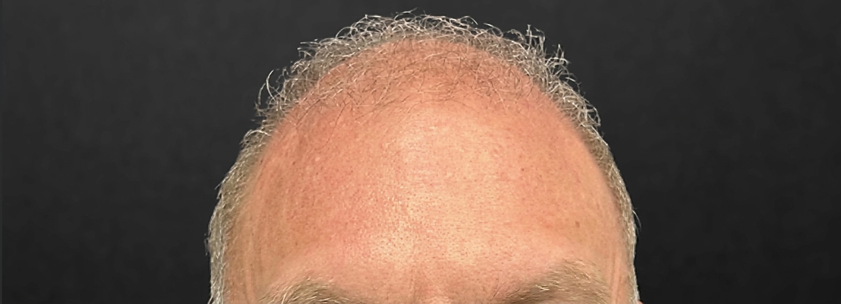Botox forehead lines before and after results, EFW MedSpa Concord CA