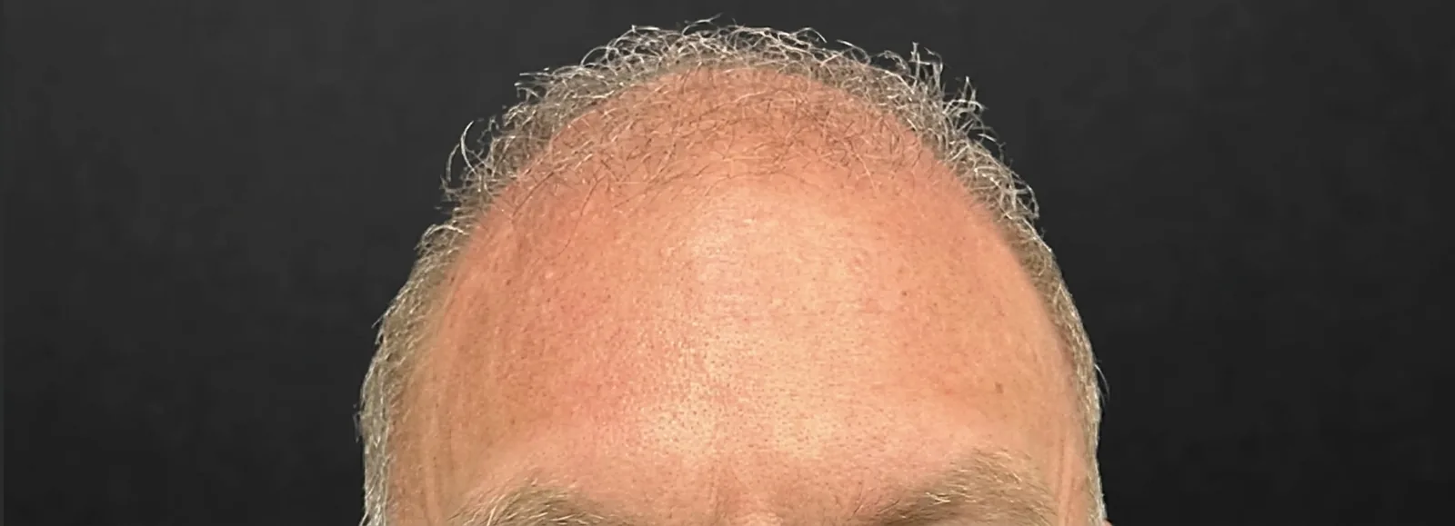 Después del tratamiento con neurotoxina