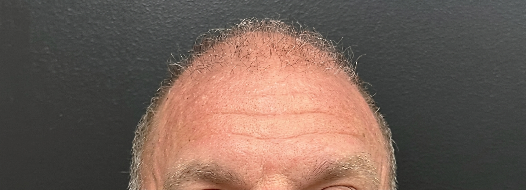 Botox forehead lines before and after results, EFW MedSpa Concord CA