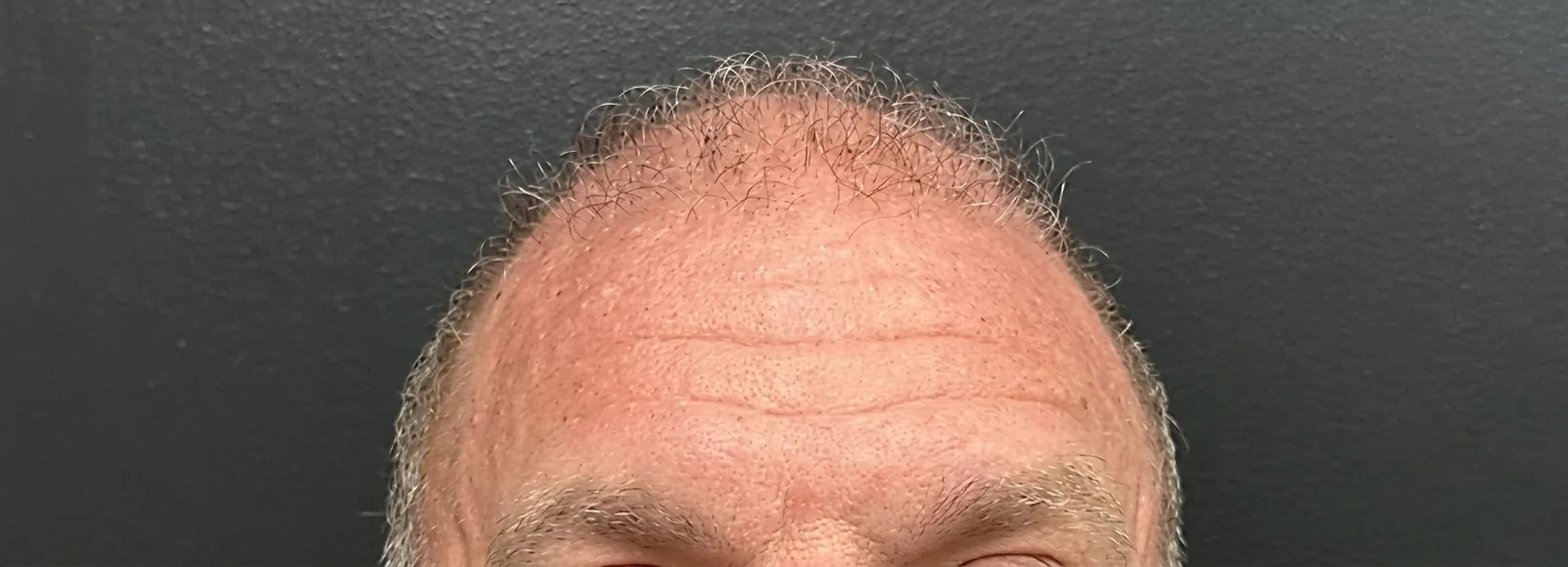 Antes del tratamiento con neurotoxina